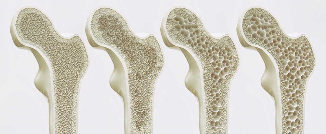 Osteoporose Darstellung